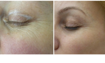 Фотона Глаза 5